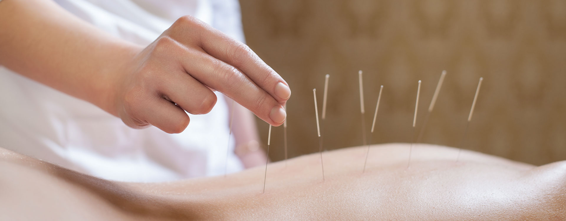 Acc-banner physiotherapist performing acupuncture in Calgary