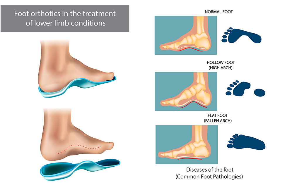 Orthotics