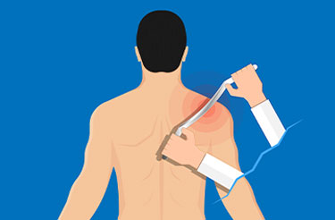 Illustration of Graston Technique tool being applied to upper back