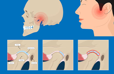 Medical illustration of jaw joint misalignment and TMJ symptoms