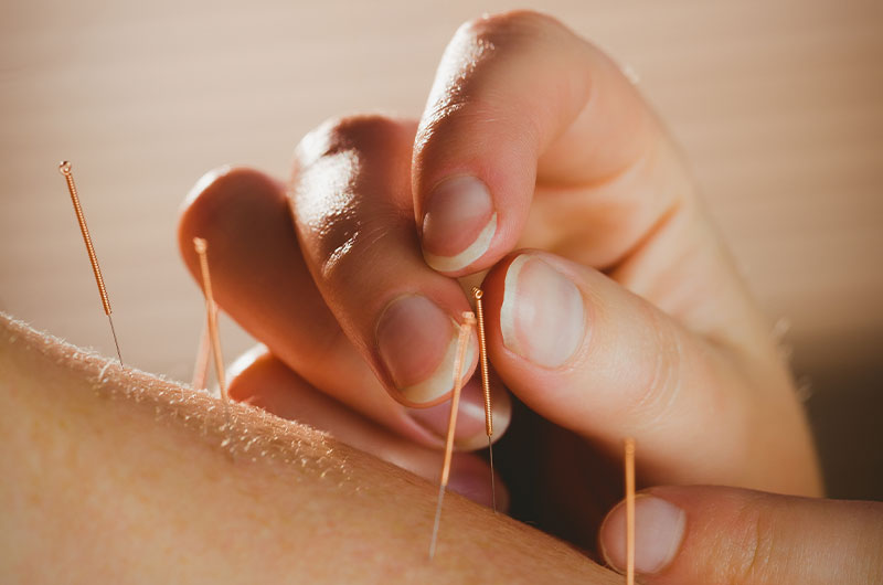 traditional-chinese Acupuncture needles placed safely in a patient’s forearm