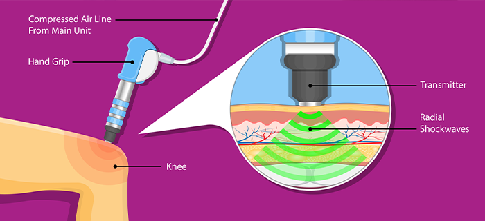 How does shoockwave therapy work