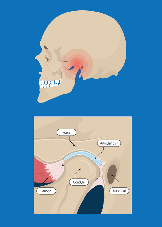 TMJ - What-is-Disorder